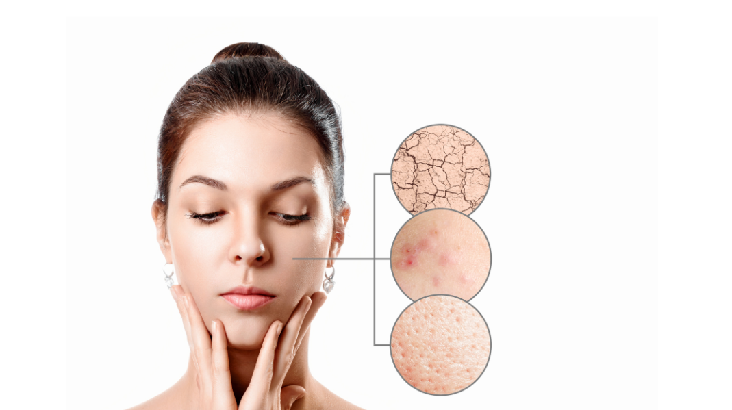 microneedling