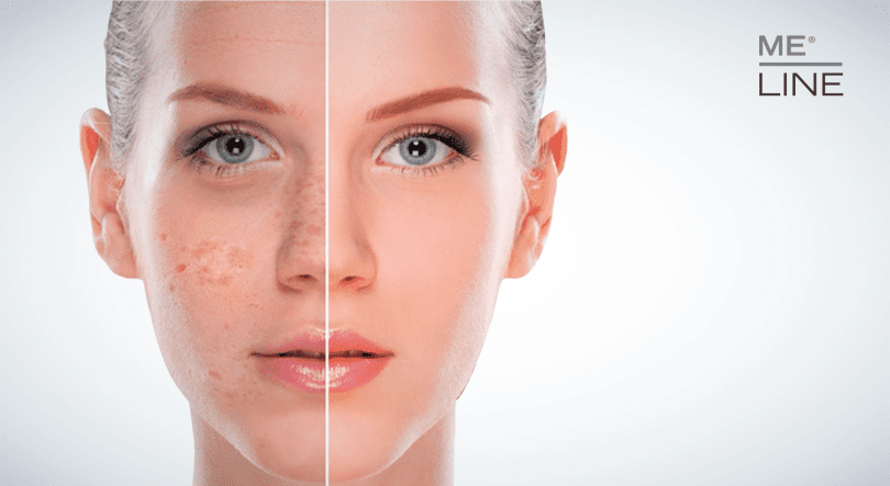 Me Line: tout savoir sur ce peeling