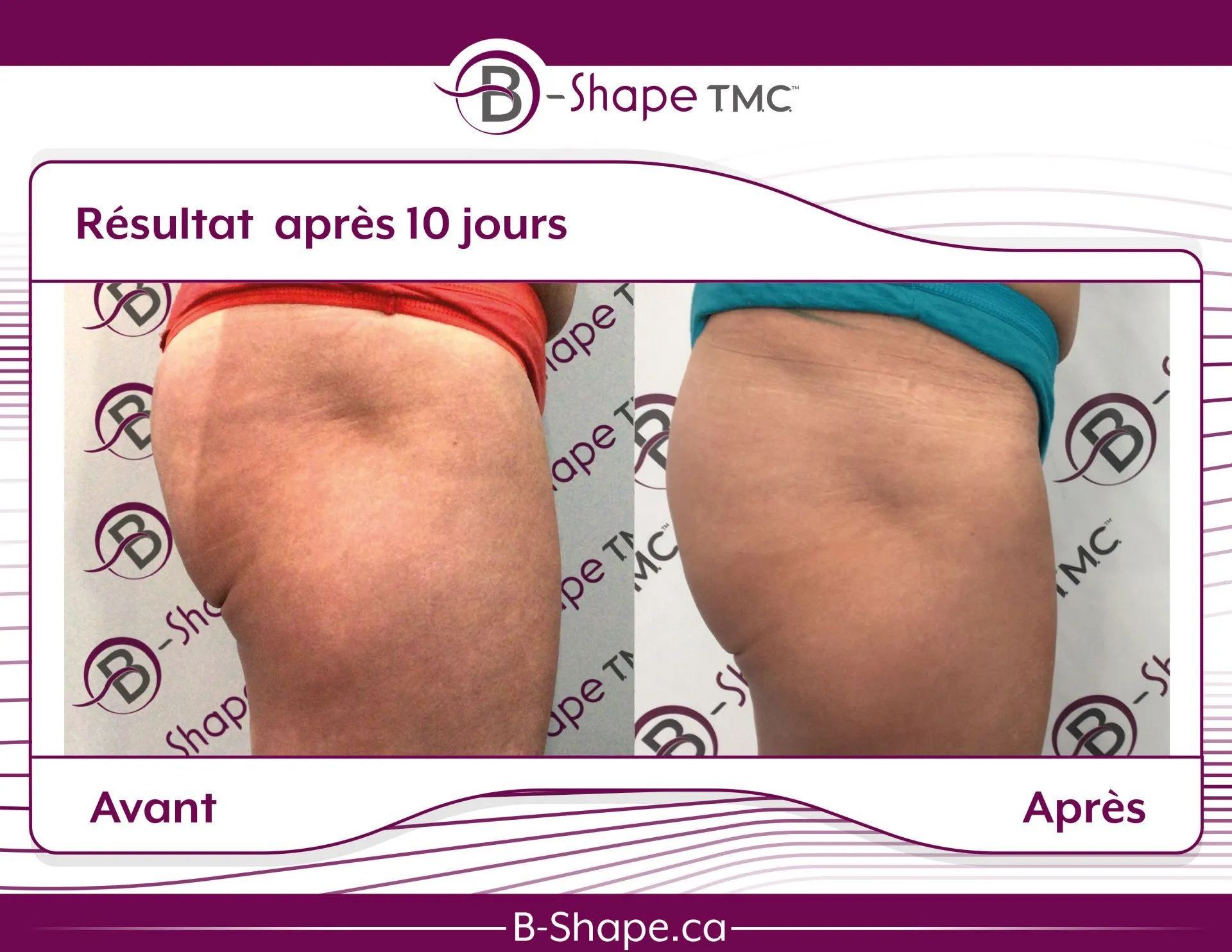 Traitement B-Shape