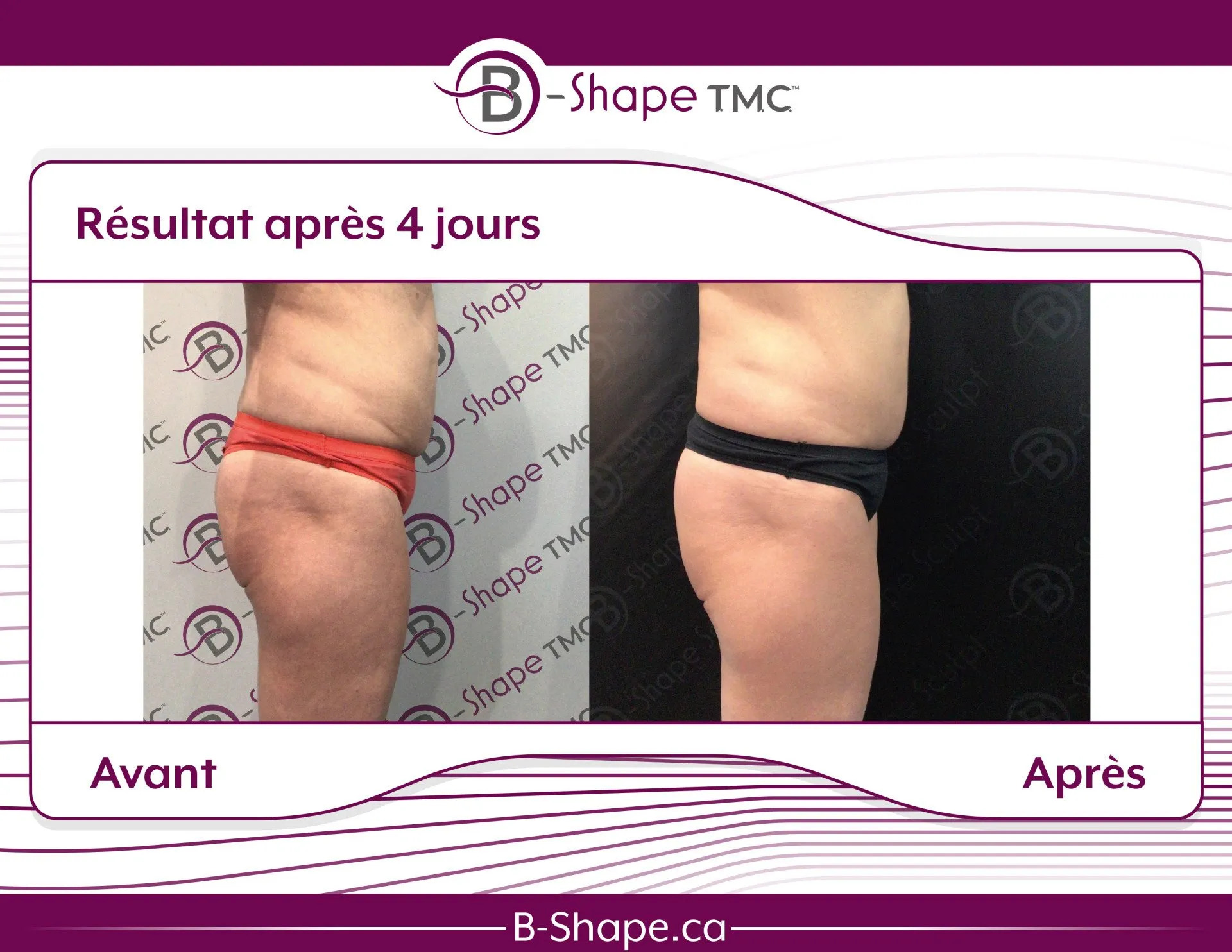 Traitement B-Shape